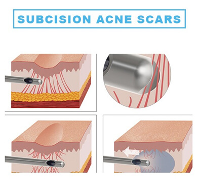 AcneScar-Treatment- Effective