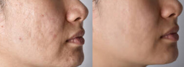 AcneScarTreatment-Subscision-Before-After