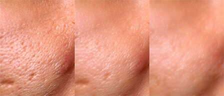 Antiaging-Laser-Treatment