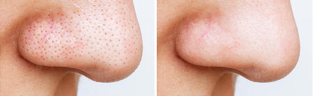 Blackhead-Whitehead-Before-After