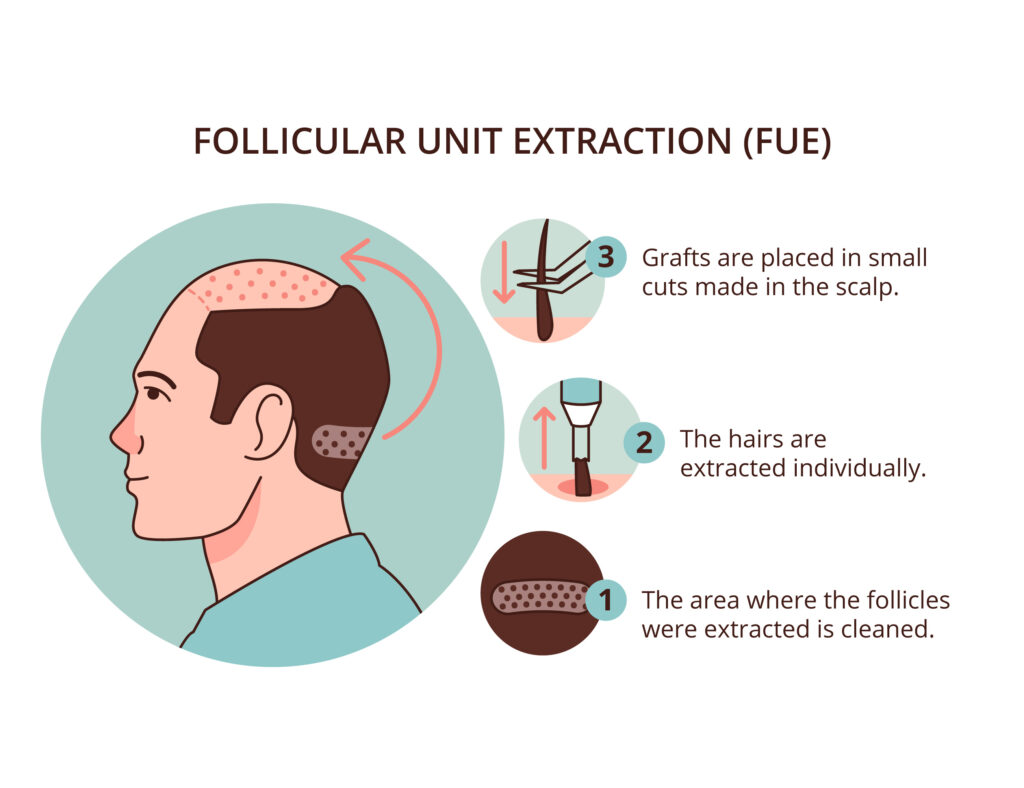 fue-hair-transplantation