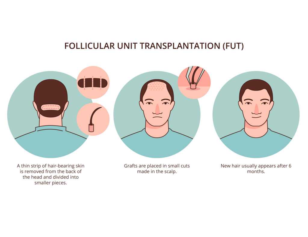 FUT-hair-transplantation