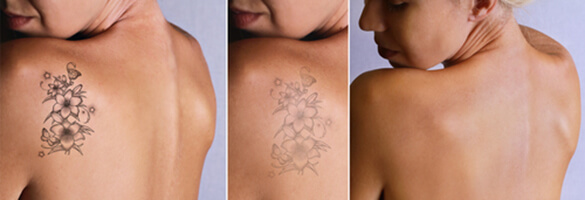 Tattoo Removal Acne Scar Laser Treatment
