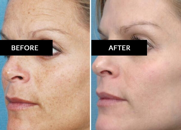 Wrinkles Hyperpigmentation IPL Treatment Before & After