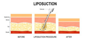 Liposuction-FatLoss-BodySculpting-Procedure