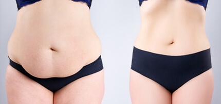 TummyTuck-BodySculpting-Treatment