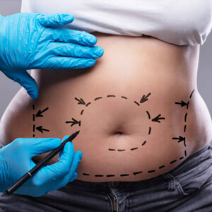 TummyTuck-StomachPlasticSurgery-FatLoss-Treatment