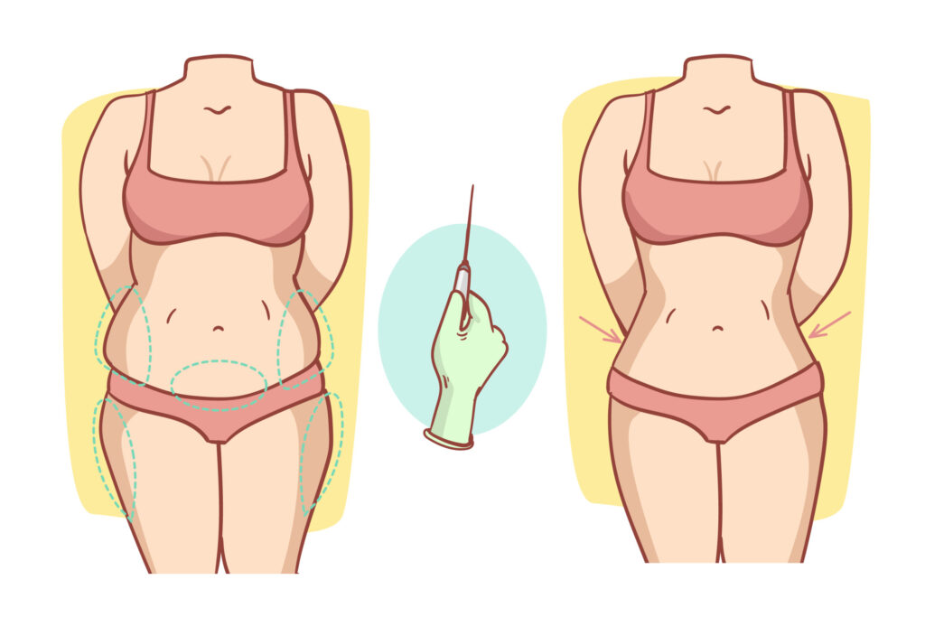 liposuction-procejure