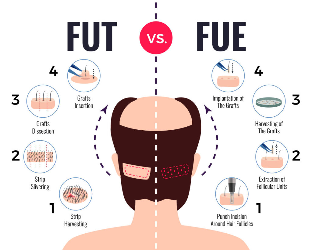 types-of-hair-transplantation